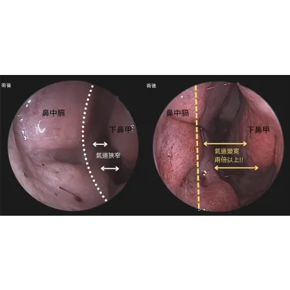 內視鏡鼻中膈矯正手術