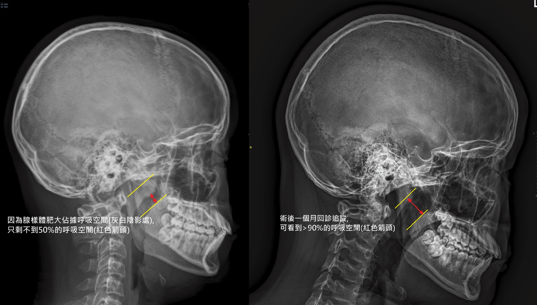兒童睡眠呼吸中止症手術與腺樣體切除臨床x光與內視鏡成效比對案例圖